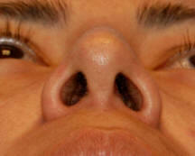 Los Angeles Nose Surgery
