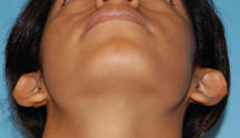 Los Angeles Otoplasty