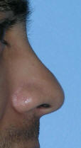 Los Angeles Nose Surgery
